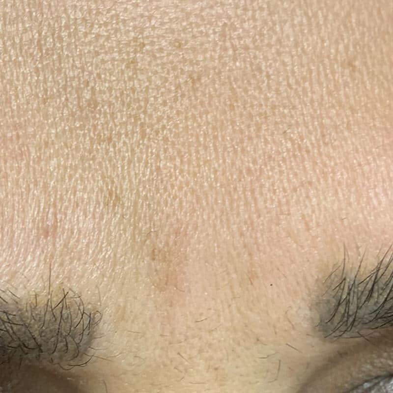anti wrinkle - bunny lines AFTER