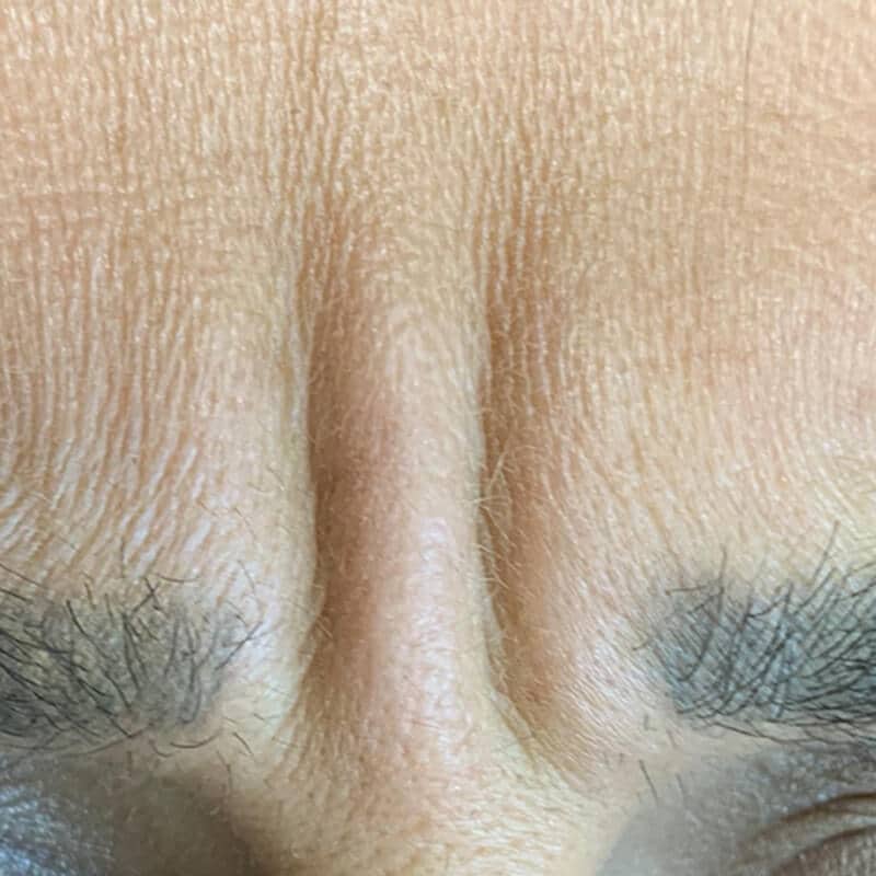anti wrinkle - bunny lines BEFORE